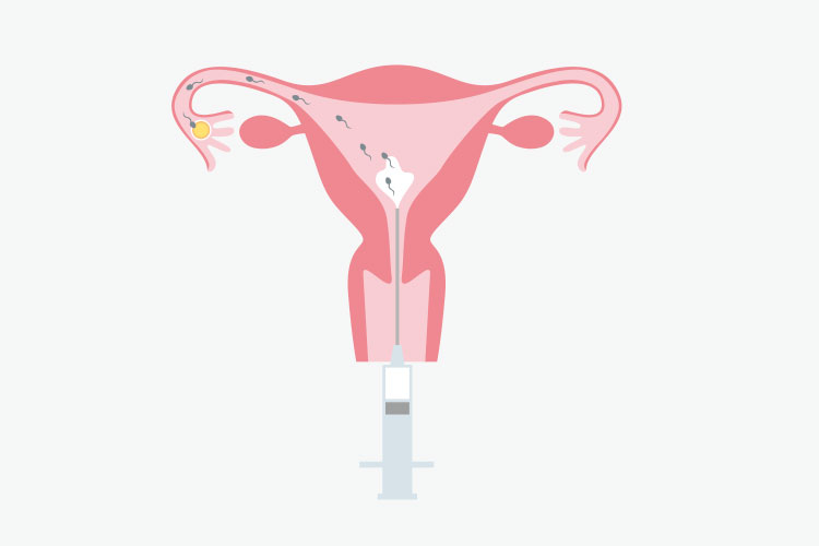 人工授精(AIH: Artificial Insemination by Husband)イメージ
